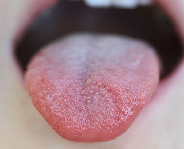 Hình ảnh viêm gai lưỡi giai đoạn 2 (trung bình)