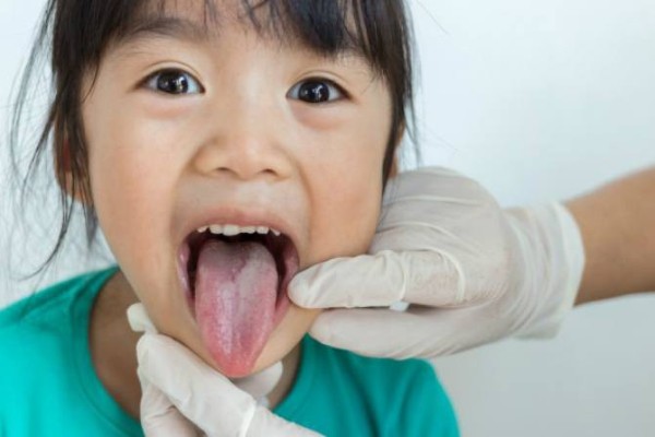 Hình ảnh viêm gai lưỡi ở trẻ em