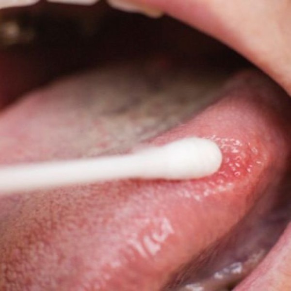 Thuốc điều trị viêm gai lưỡi – Giải pháp y khoa an toàn, hiệu quả