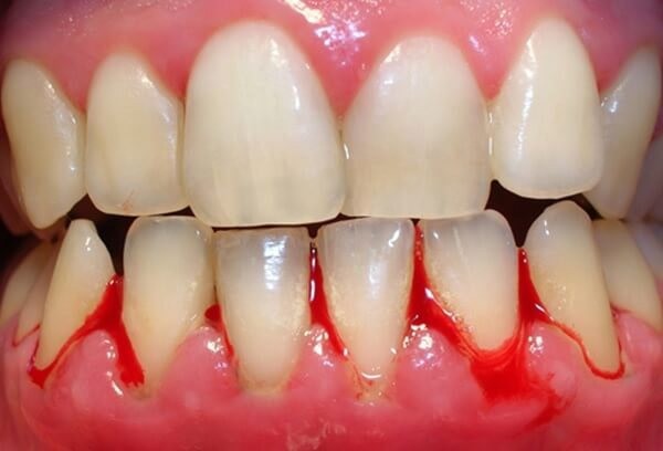 Viêm nướu răng là bệnh gì?