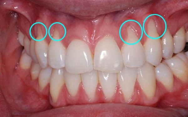 Triệu chứng viêm nướu răng thường gặp