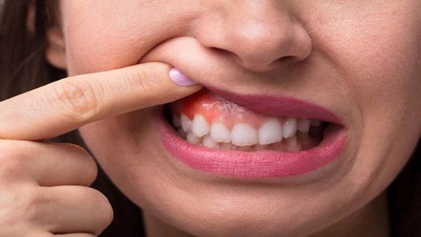 Hình ảnh viêm nướu chân răng