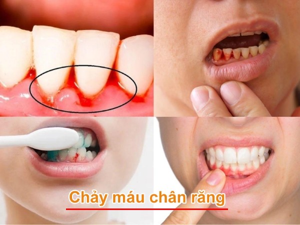 Viêm lợi hàm dưới chảy máu