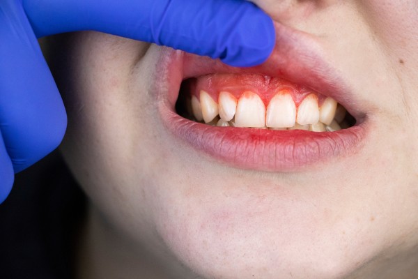 Hình ảnh viêm nướu răng hàm trên