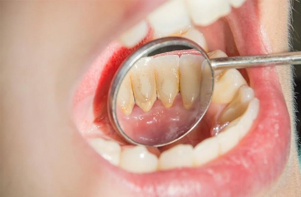Cao răng là gì và tại sao cần lấy cao răng?