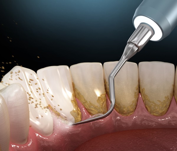 Lấy cao răng có đau không? Giải đáp chi tiết