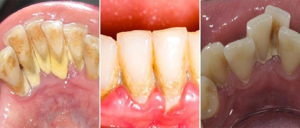 Lấy cao răng có làm tổn thương nướu không?