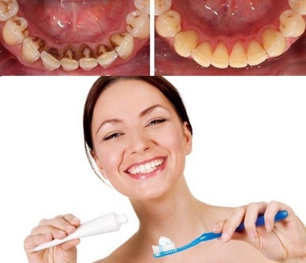 Chăm sóc sau khi lấy cao răng đúng cách
