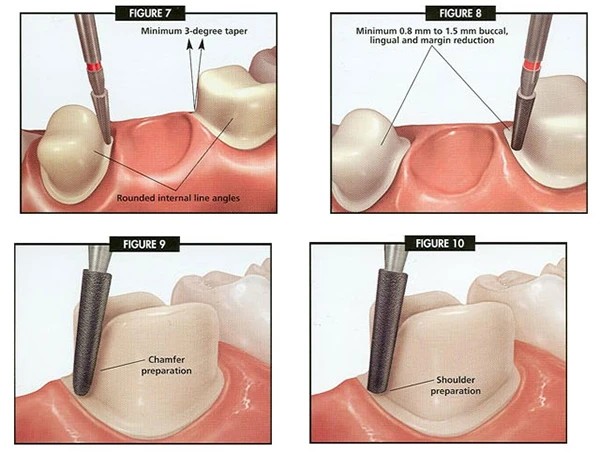 Các kỹ thuật mài cùi răng hiện đại