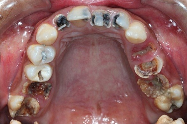 Chi phí điều trị tủy răng