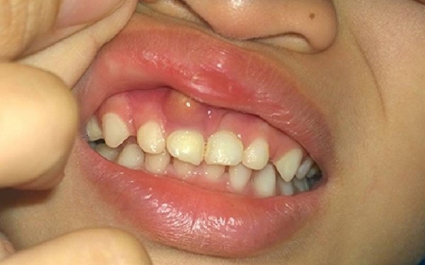 Điều trị sớm các vấn đề răng tiềm ẩn