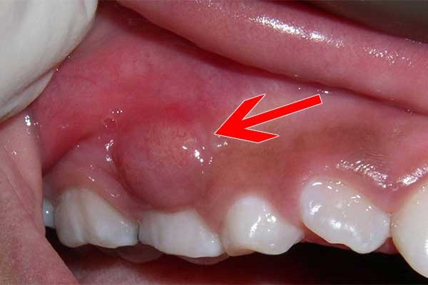 Nhức răng kinh khủng do áp xe răng và nhiễm trùng nha chu 