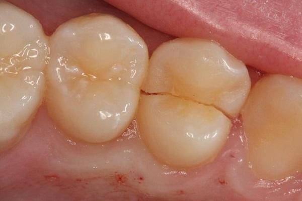 Nhức răng kinh khủng do răng bị nứt, mẻ hoặc gãy
