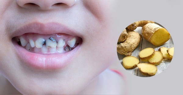 Các phương pháp dân gian hiệu quả (đinh hương, tỏi, gừng) trị nhức răng kinh khủng