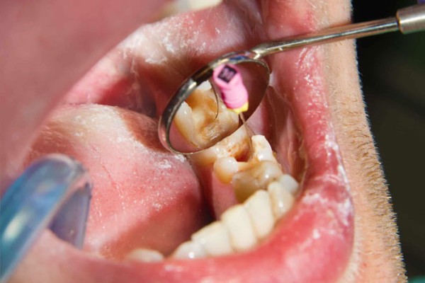 Điều trị tủy răng (nội nha)