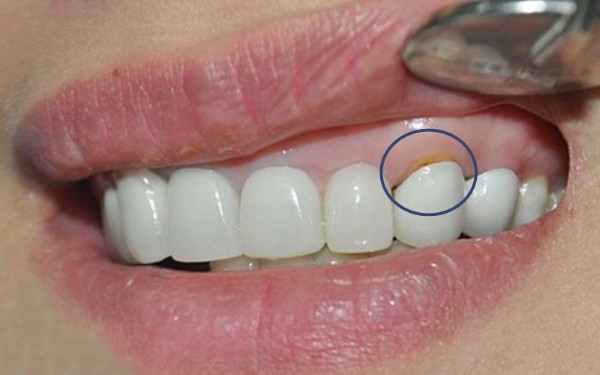 Bọc răng sứ là gì? Thời gian sử dụng răng sứ kéo dài bao lâu?
