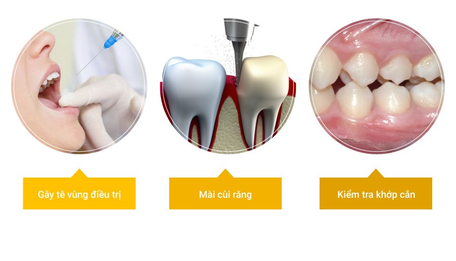 Gây tê, mài cùi răng, lấy dấu và gắn răng tạm