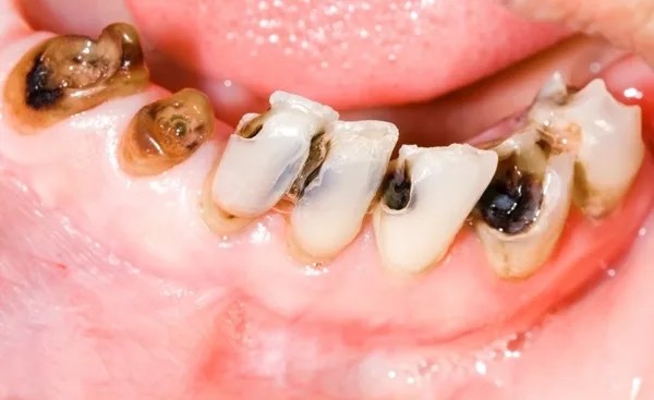 Hậu quả nghiêm trọng khi răng bọc sứ bị viêm tủy 