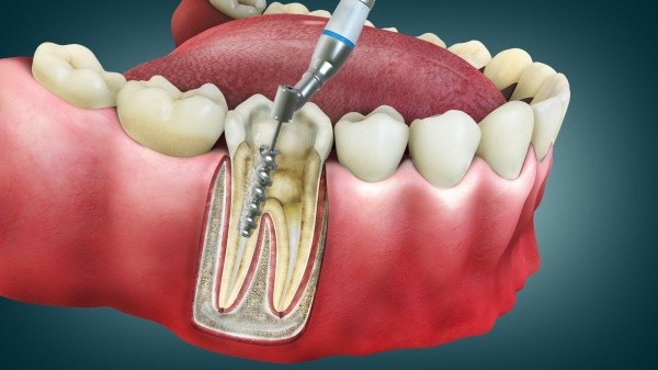 Cách khắc phục răng bọc sứ bị viêm tủy hiệu quả 