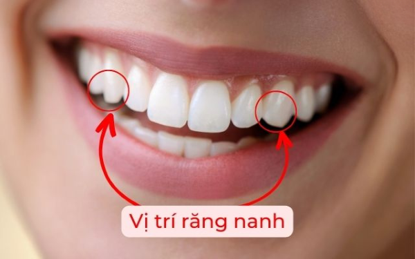 Vị trí của răng nanh trên cung hàm