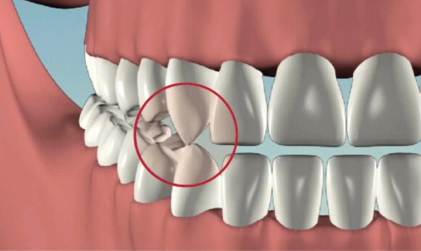 Chức năng của răng nanh