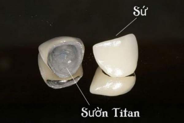 Răng sứ Titan là gì?