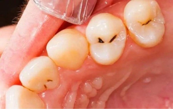Các triệu chứng khi bị sâu chân răng cần lưu ý