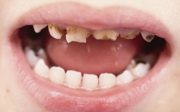 Cách phân biệt răng sún và răng sâu ở trẻ nhỏ