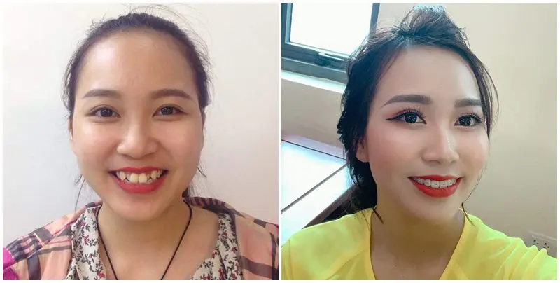 Niềng răng mắt cài sứ sang trọng, định hình răng và khuôn mặt tốt hơn
