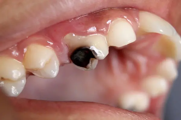 Triệu chứng xiết ăn răng là gì?