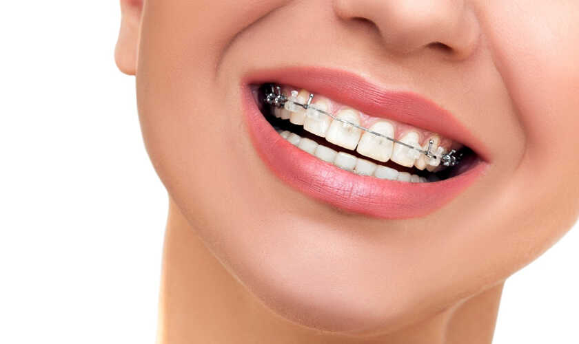 Quy trình cơ bản khi niềng răng 1 hàm chuẩn
