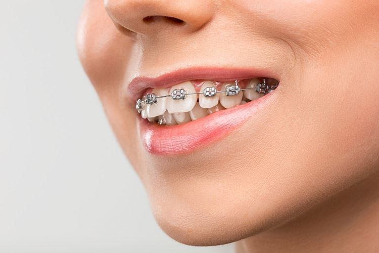 Có bao nhiêu phương pháp điều trị răng lồi xỉ?