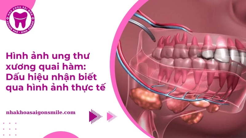 Hình ảnh ung thư xương quai hàm: Dấu hiệu nhận biết qua hình ảnh thực tế