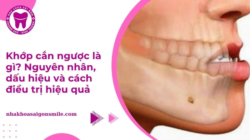Khớp cắn ngược là gì? Nguyên nhân, dấu hiệu và cách điều trị hiệu quả