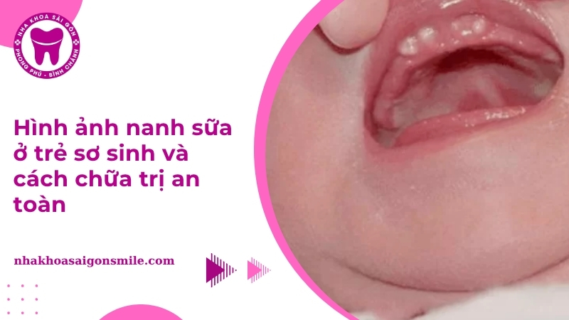 Hình ảnh nanh sữa ở trẻ sơ sinh và cách chữa trị an toàn