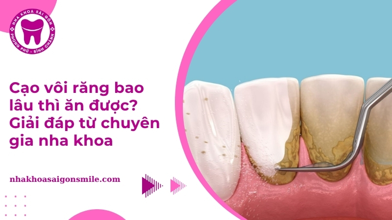 Cạo vôi răng bao lâu thì ăn được? Giải đáp từ chuyên gia nha khoa