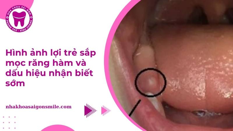 Hình ảnh lợi trẻ sắp mọc răng hàm và dấu hiệu nhận biết sớm