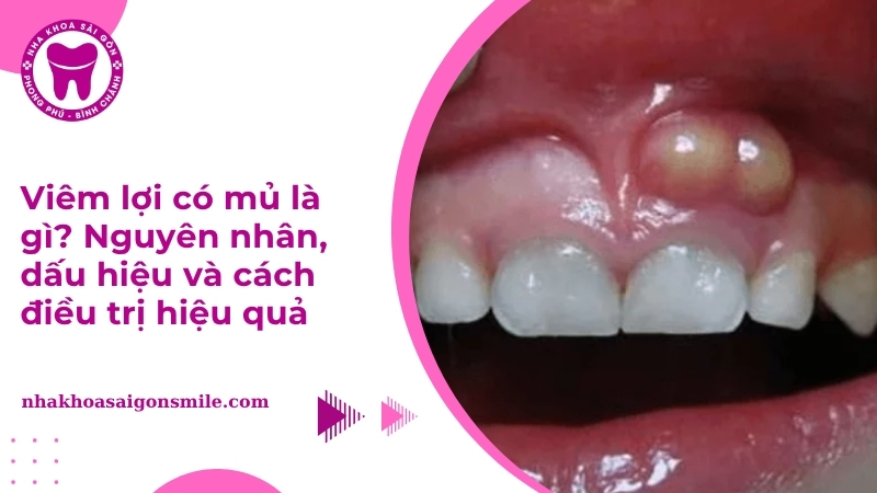 Viêm lợi có mủ là gì? Nguyên nhân, dấu hiệu và cách điều trị hiệu quả