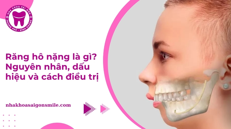Răng hô nặng là gì? Nguyên nhân, dấu hiệu và cách điều trị