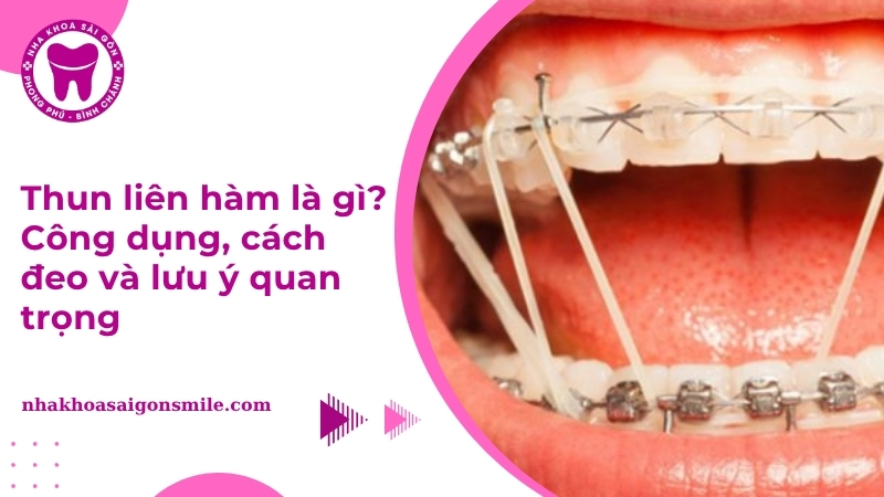 Thun liên hàm là gì? Công dụng, cách đeo và lưu ý quan trọng