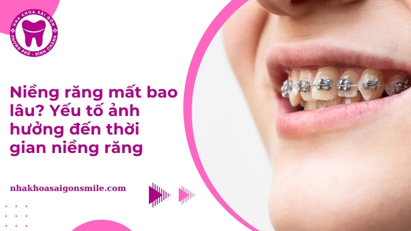Thời gian niềng răng mất bao lâu thì đẹp nhất?