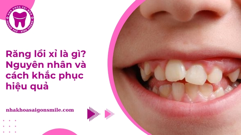 Răng lồi xỉ là gì? Nguyên nhân và cách điều trị hiệu quả
