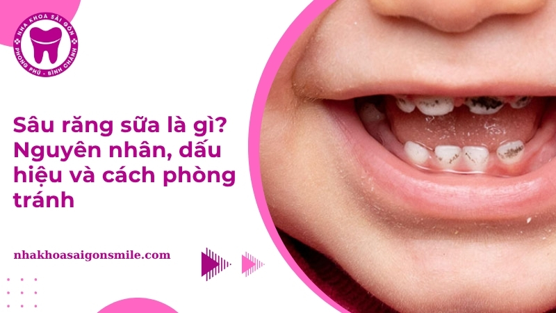 Sâu răng sữa: Dấu hiệu, nguyên nhân và cách điều trị