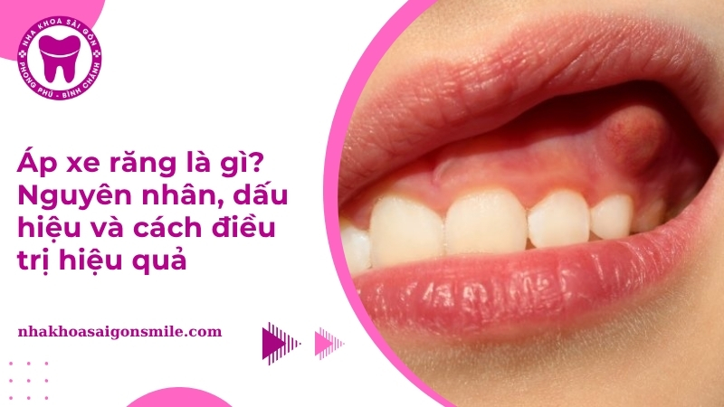Áp xe răng: Dấu hiệu, nguyên nhân và cách điều trị