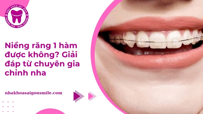 Niềng răng 1 hàm được không? Chi phí bao nhiêu tiền?