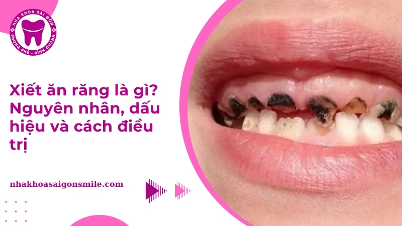 Xiết ăn răng: Nguyên nhân, triệu chứng và cách phòng ngừa