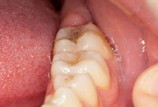 Nguyên nhân sưng nướu răng trong cùng ở bà bầu