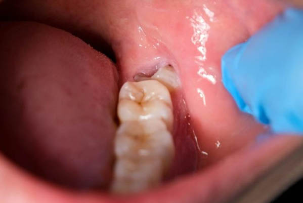 Dấu hiệu nhận biết sưng nướu răng trong cùng ở bà bầu