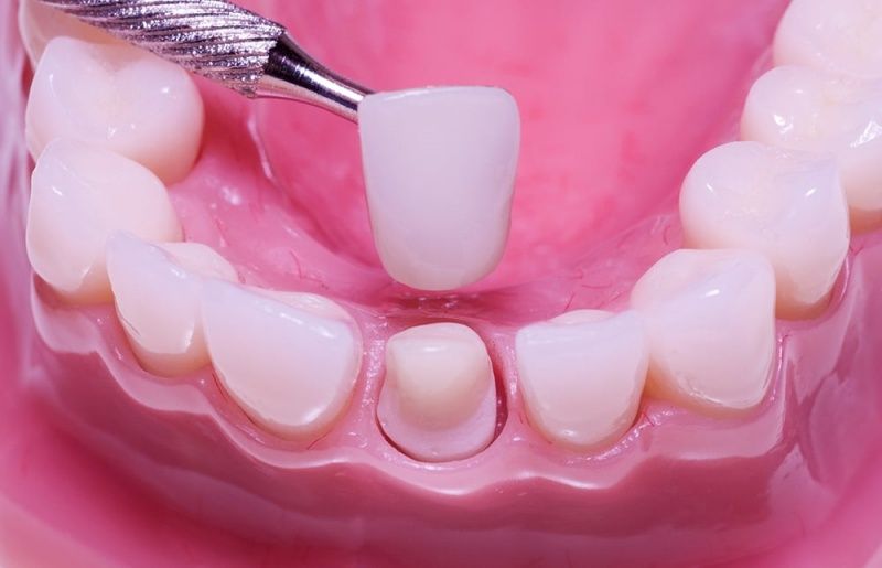 Bọc răng sứ có đau không?