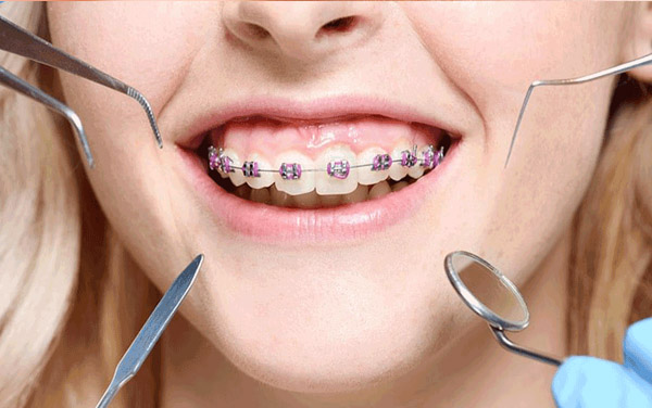 Các giai đoạn niềng răng và sự thay đổi xuyên suốt